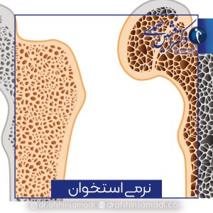 درد استئومالاسی یا نرمی استخوان