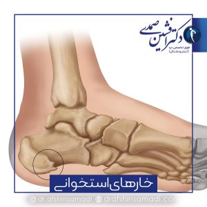 خارهای استخوانی چیست و چه درمانی دارد؟