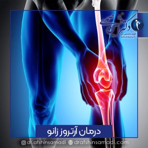 درمان آرتروز زانو