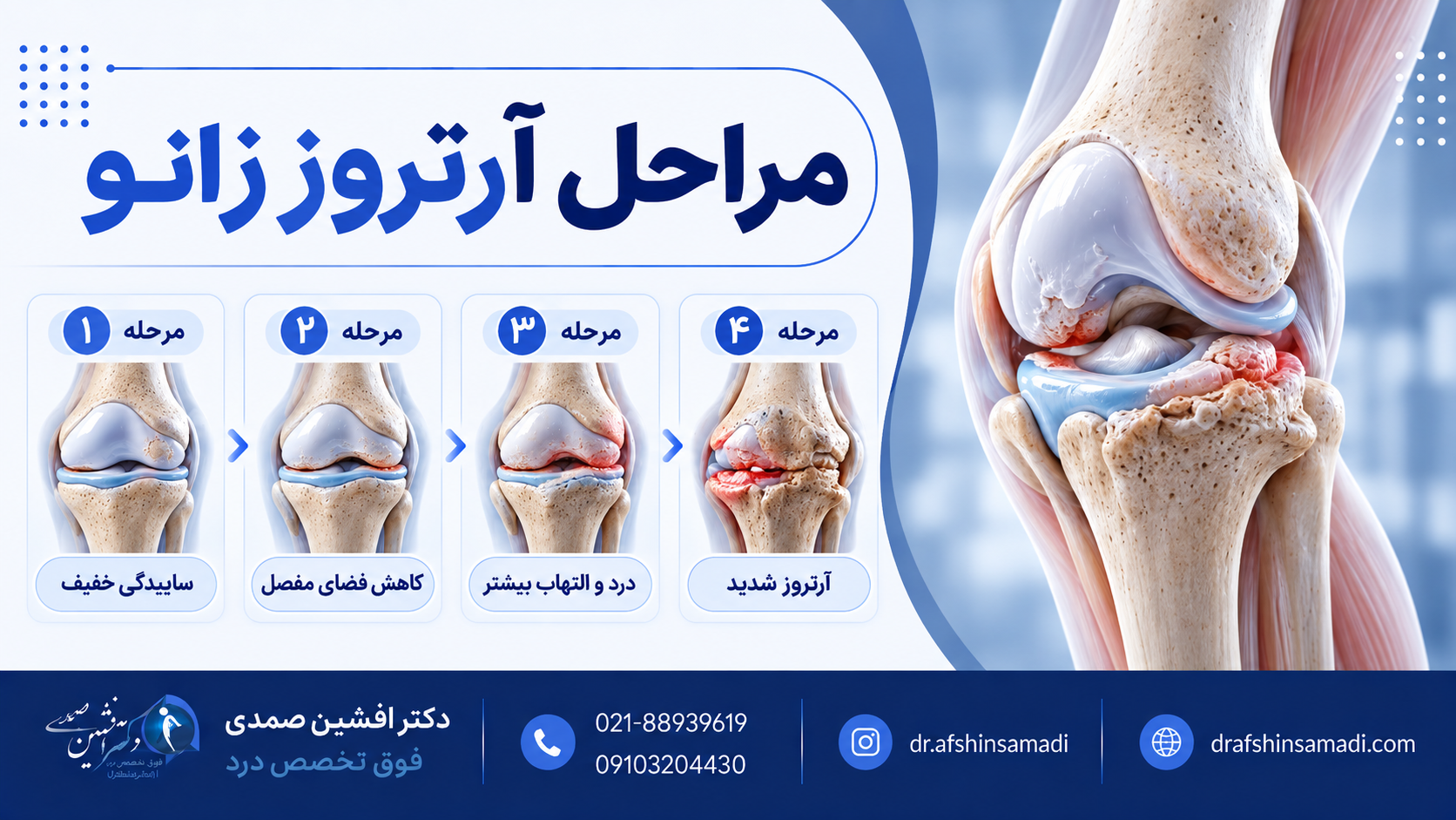 مراحل آرتروز زانو
