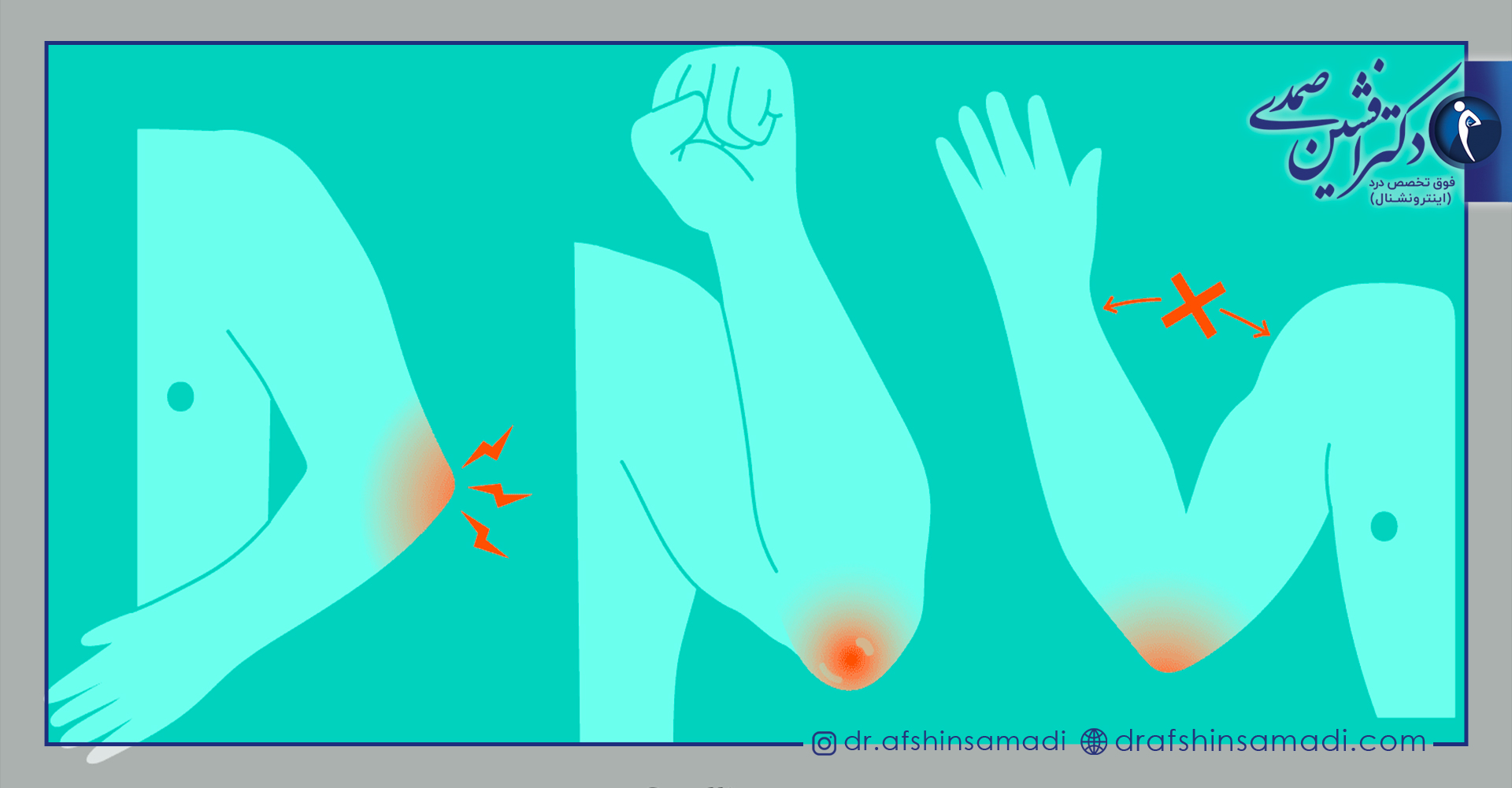 علائم بورسیت