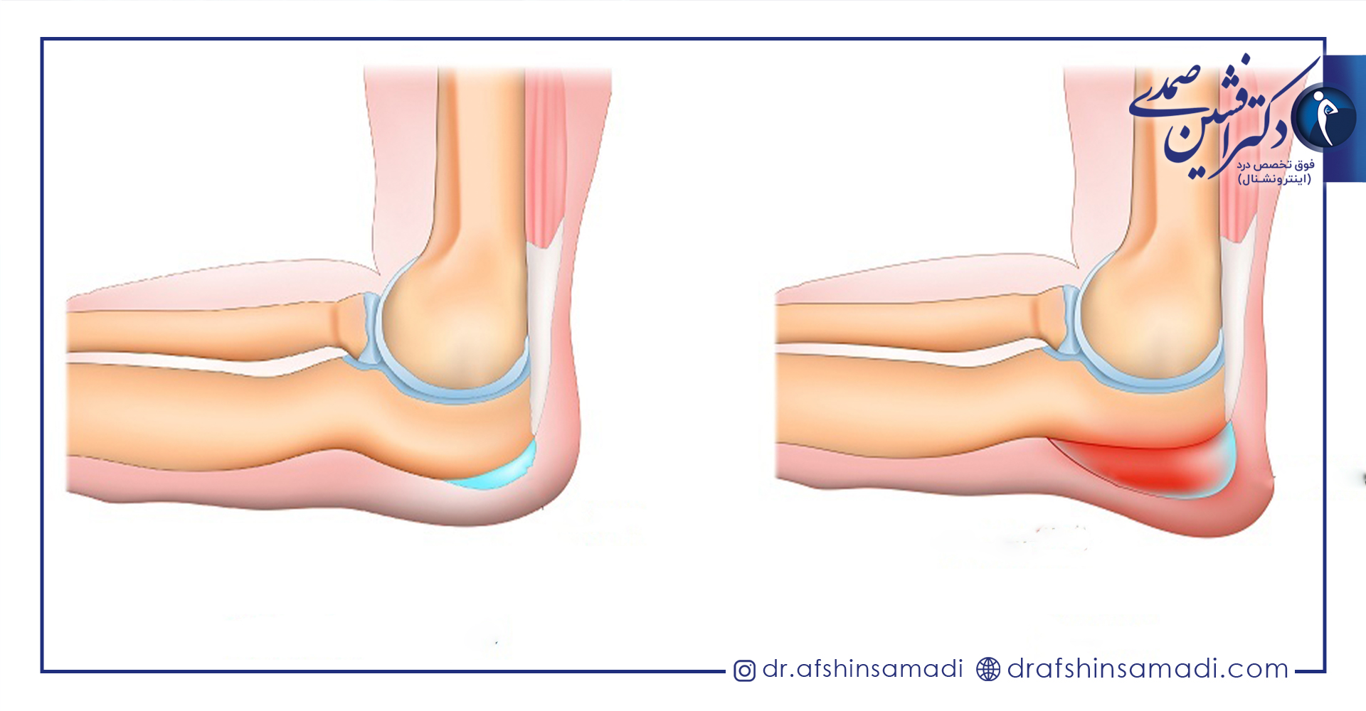 انواع بورسیت