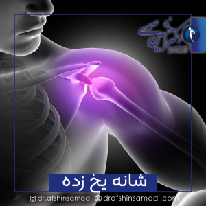 درمان شانه یخ زده