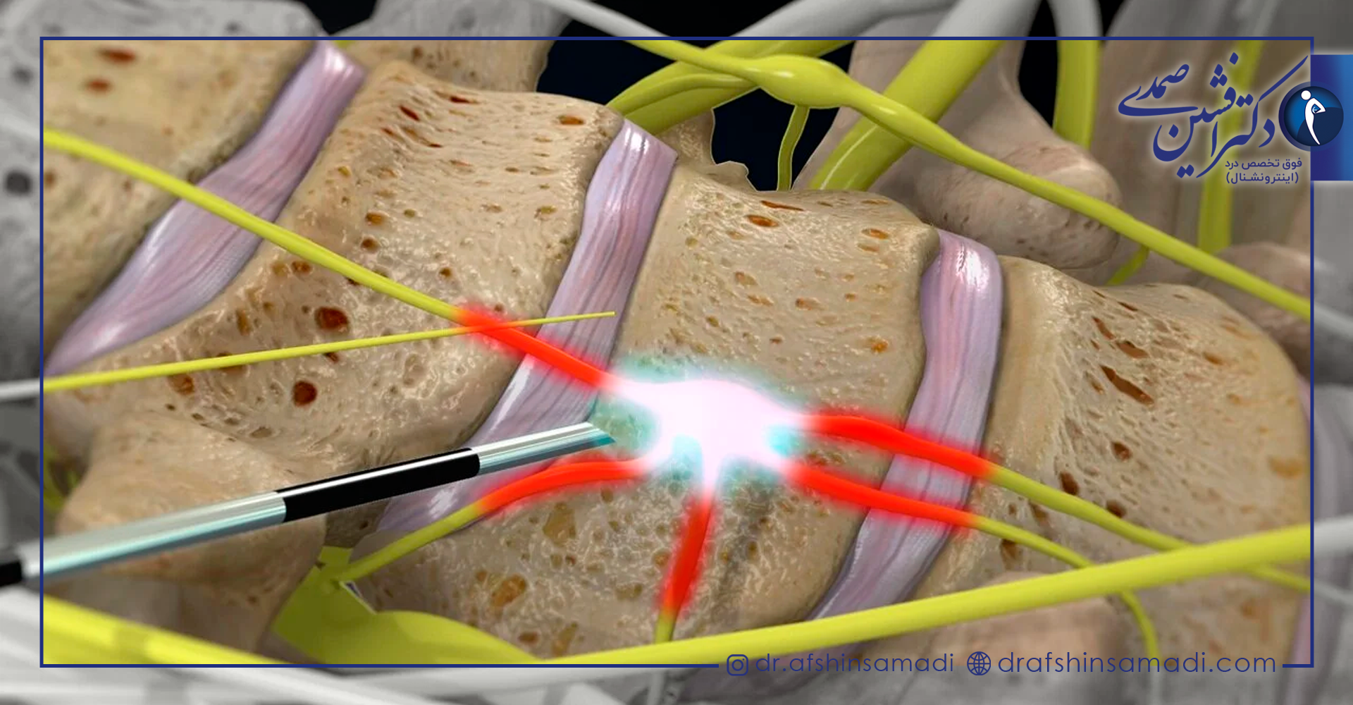 پنجمین نوع بلاک عصب