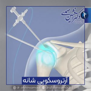 آرتروسکوپی شانه