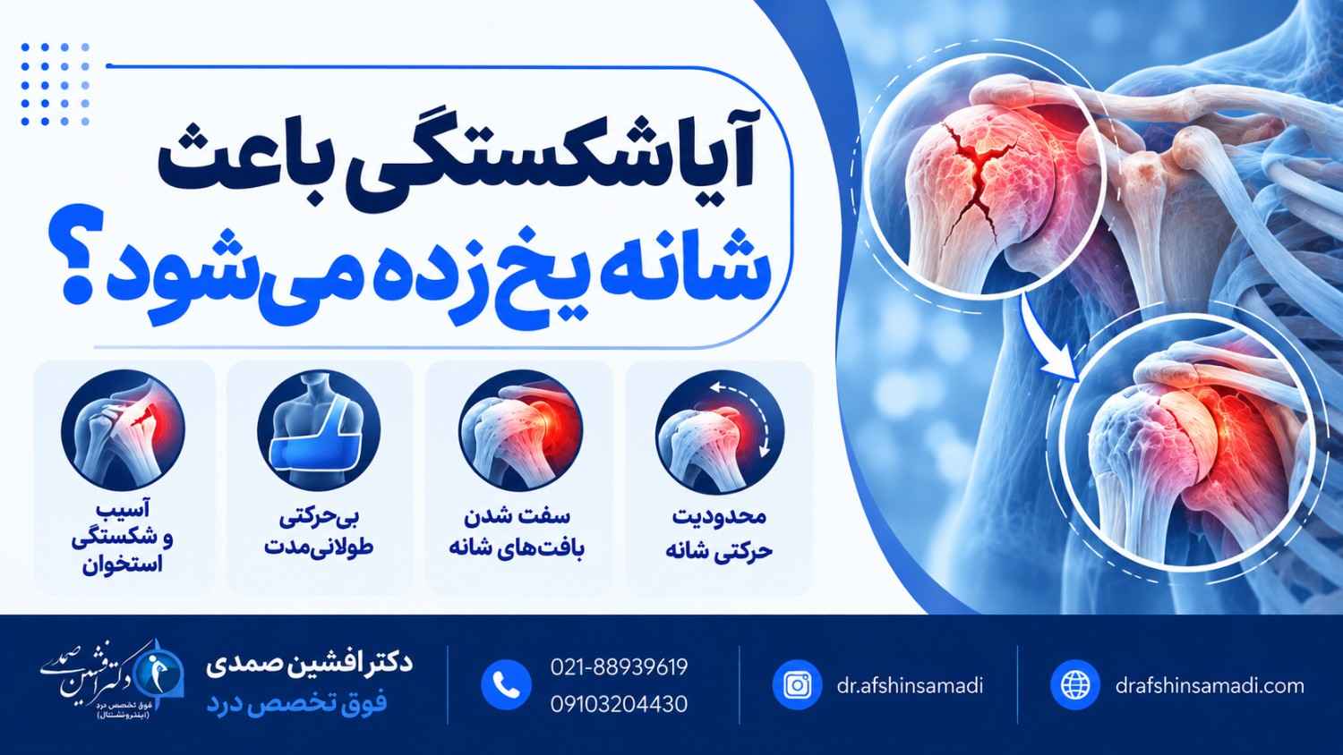 آیا شکستگی باعث شانه یخ زده می‌شود؟